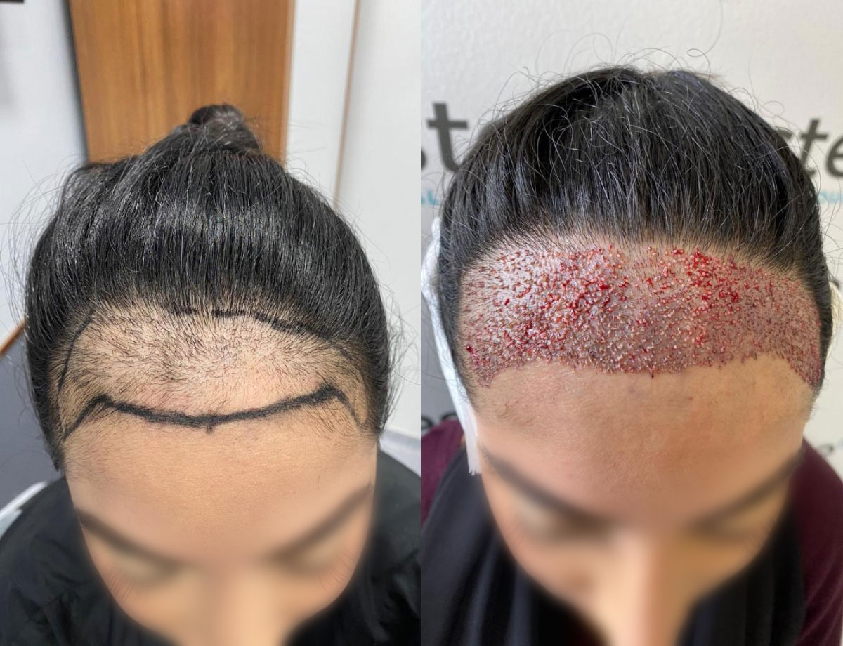 FUE Hair Transplant Procedure