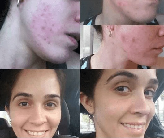 Acne Scars