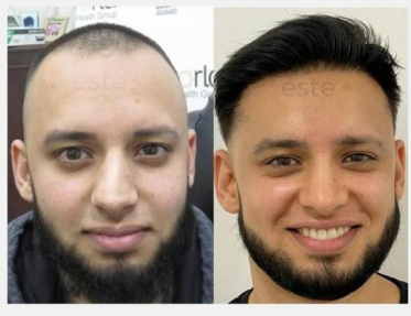 What makes FUE Hair Transplant Procedure the most Successful Technique?