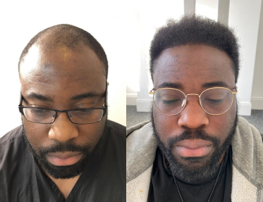 What makes FUE Hair Transplant Procedure the most Successful Technique?