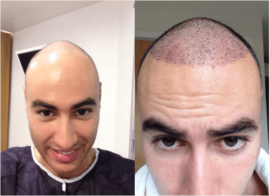 FUE hair transplant surgery before and after