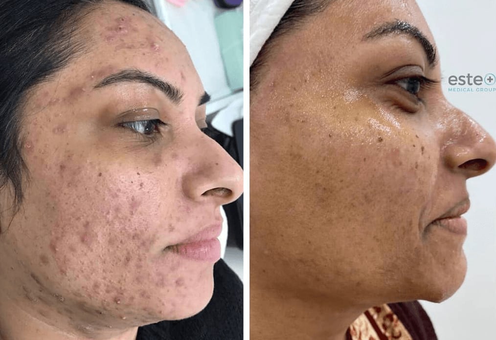 Acne Scars