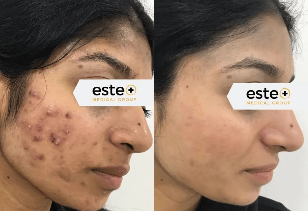 Acne Scars