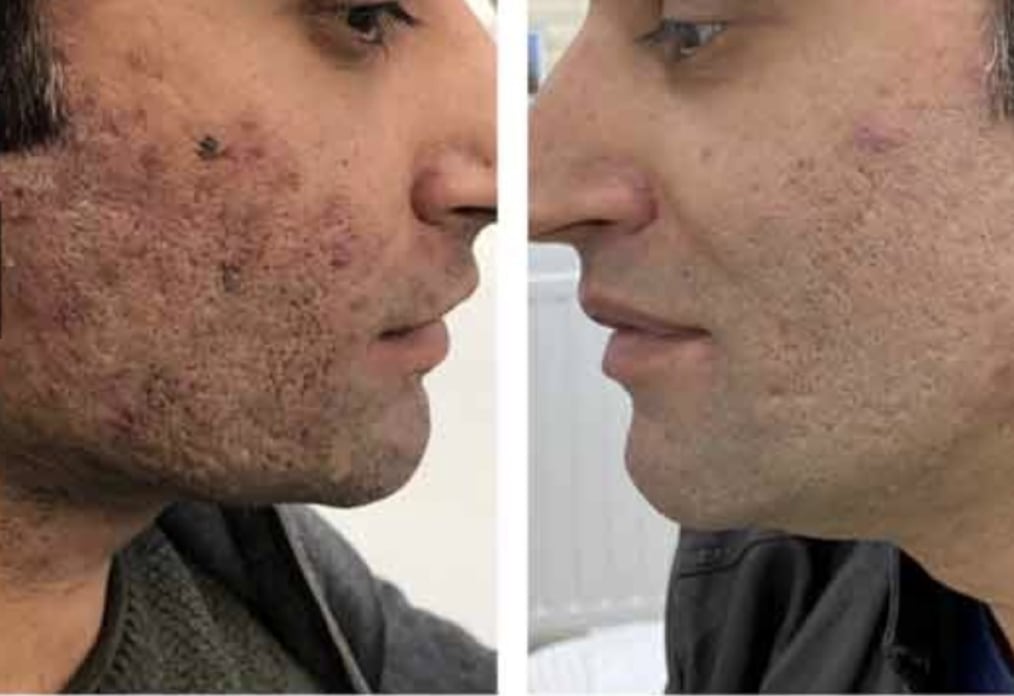 Acne Scars