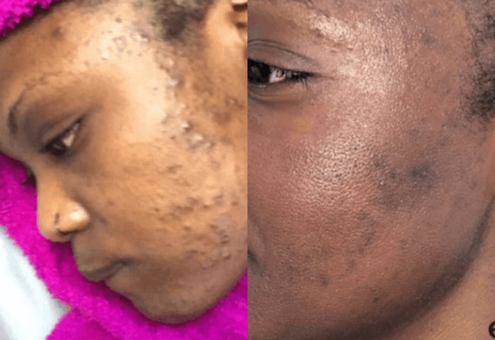 Acne Scars